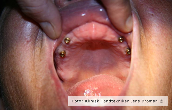 Helprotese 2 Klinisk Tandtekniker Jens Broman