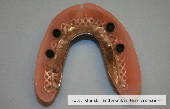 helprotese Klinisk Tandtekniker Jens Broman