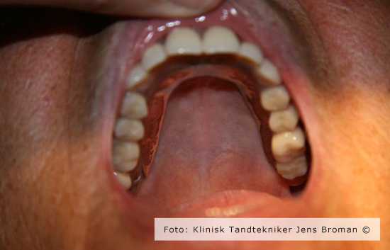 færdig helprotese i mund Klinisk Tandtekniker Jens Broman