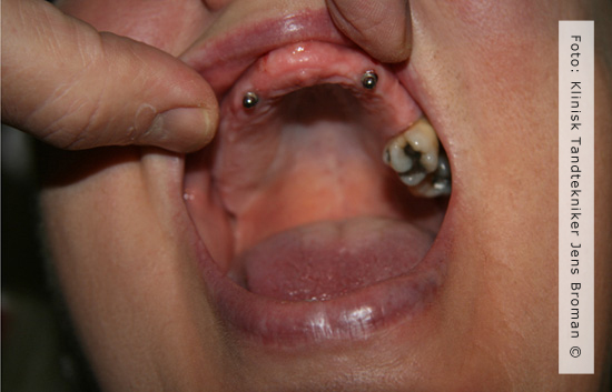 Kombination af implantat og naturlig rod af Klinisk Tandtekniker Jens Broman